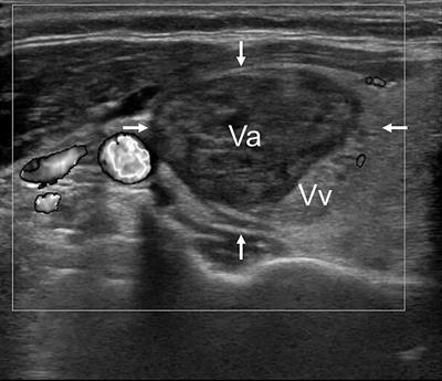 Initial Ablation Ratio Predicts Volume Reduction and Retreatment After 5 Years From Radiofrequency Ablation of Benign Thyroid Nodules